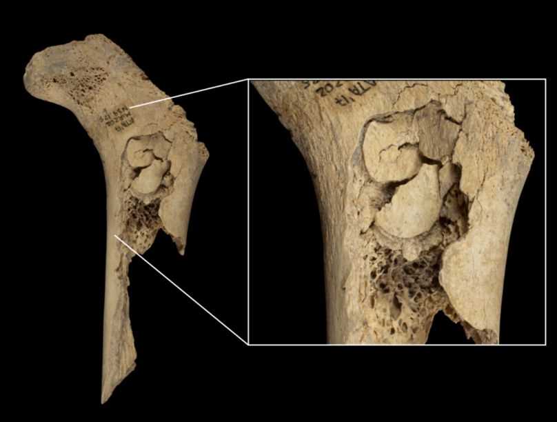 Image of a child's femur punctured to extract the marrow