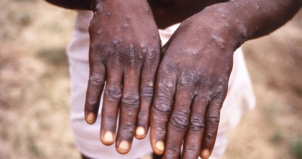 Namibia confirms first Mpox case