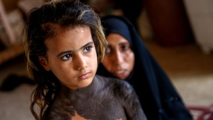 Dans un village d'Irak, une fillette mise au ban à cause d'une maladie congénitale
