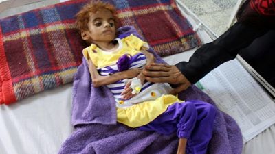 Au Yémen, le désespoir des médecins face aux enfants affamés