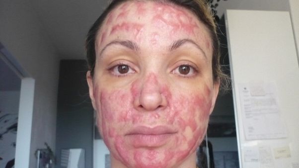 Ex modella sfigurata dalla chirurgia Ex modella sfigurata dalla chirurgia