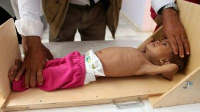 Malnutrition: un poids "inacceptable" pour la planète 