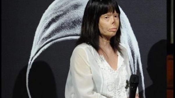 Sfigurata da marito: dubbi su morte ex Sfigurata da marito: dubbi su morte ex