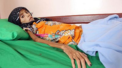 فتاة تعاني سوء التغذية تلخص تأثير الحرب وانهيار اقتصاد اليمن