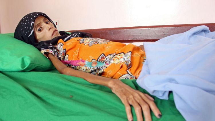 فتاة تعاني سوء التغذية تلخص تأثير الحرب وانهيار اقتصاد اليمن