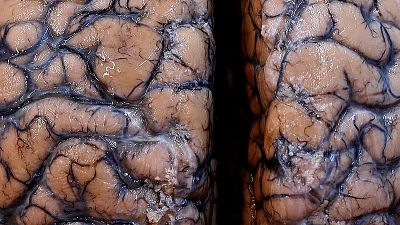 Scientists turn brain signals into speech, may help people who cannot talk Scientists turn brain signals into speech, may help people who cannot talk
