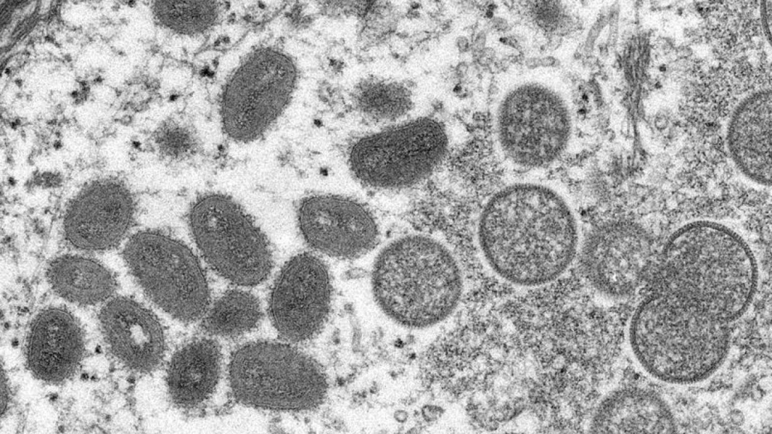 El número de casos de viruela del mono en España se eleva a 186 -Ministerio de Sanidad