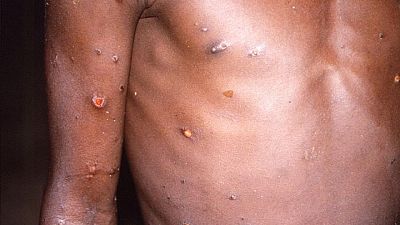 Britain offers smallpox shot as monkeypox cases spread in Europe